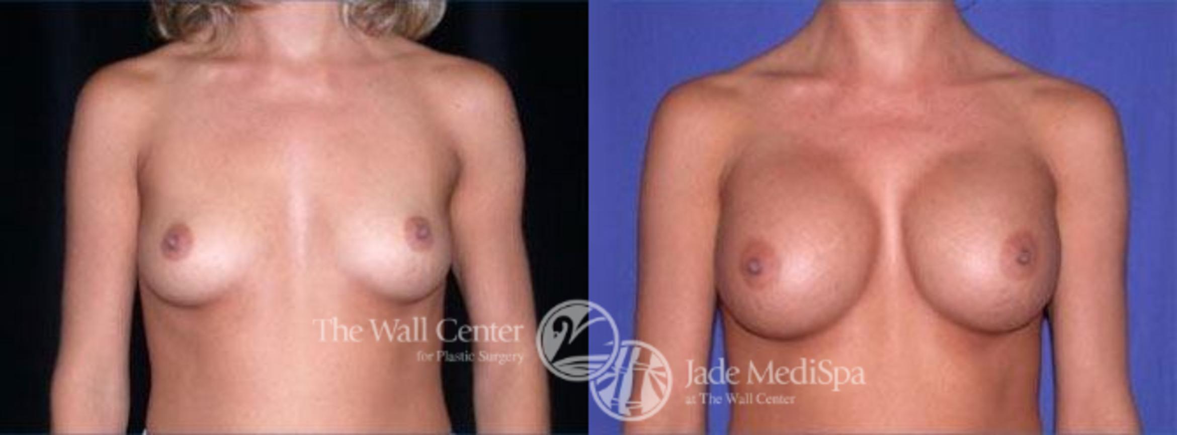 Breast Augmentation Case 101 Before & After View #1 | Shreveport, LA | The Wall Center