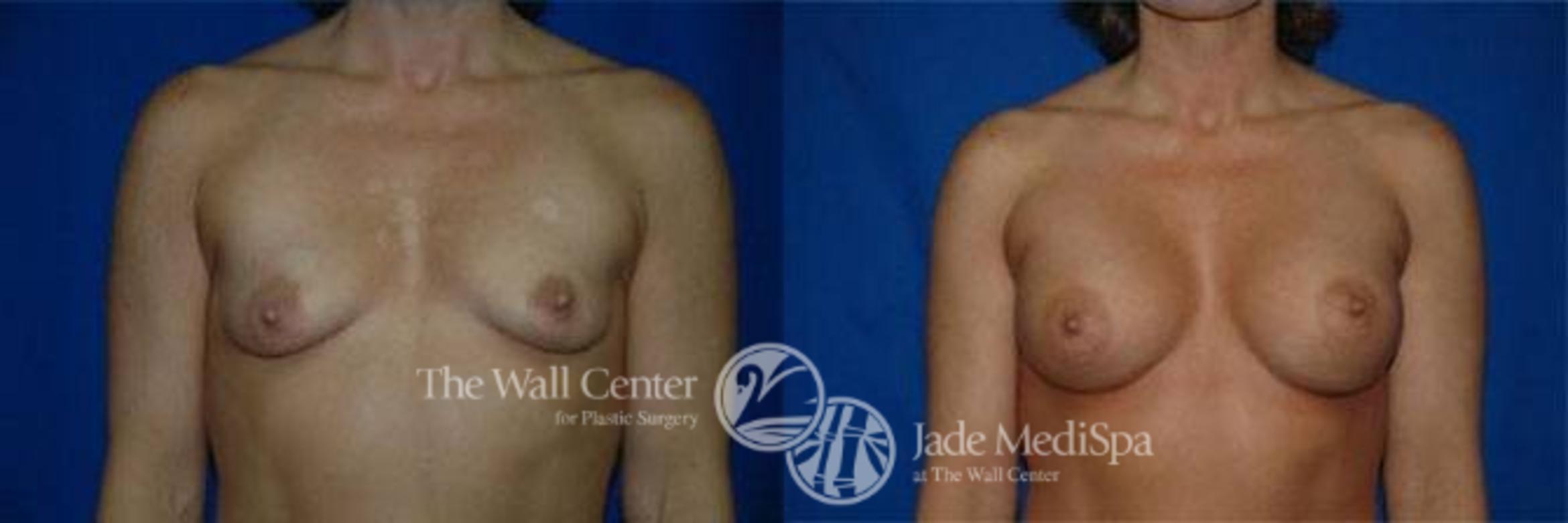 Breast Augmentation Case 104 Before & After View #1 | Shreveport, LA | The Wall Center