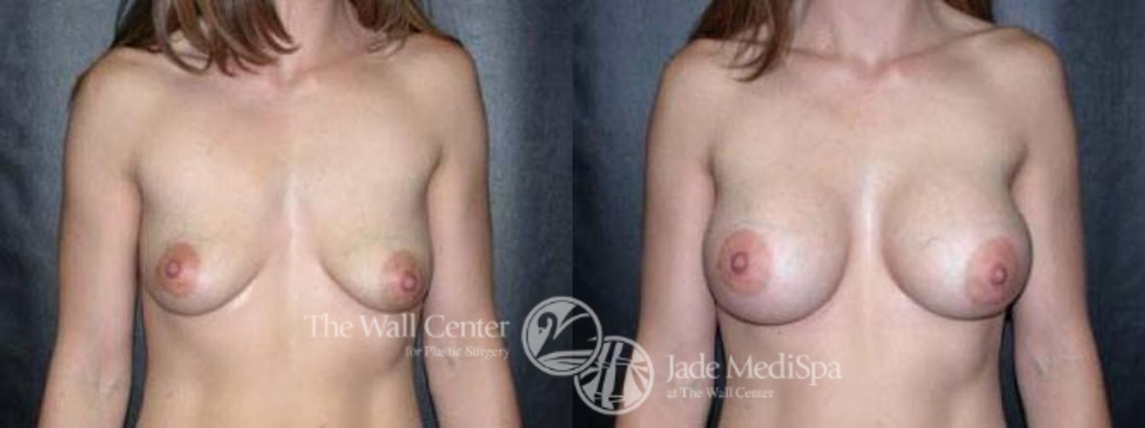 Breast Augmentation Case 106 Before & After View #1 | Shreveport, LA | The Wall Center