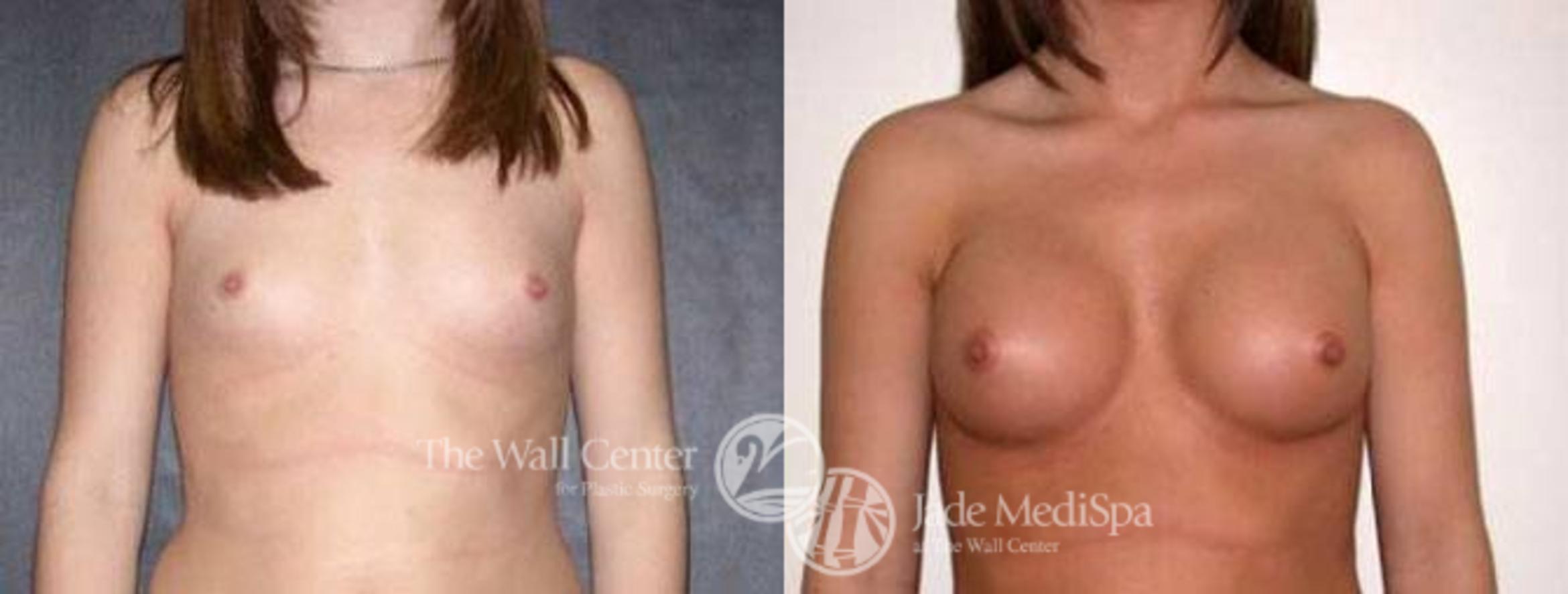 Breast Augmentation Case 107 Before & After View #1 | Shreveport, LA | The Wall Center