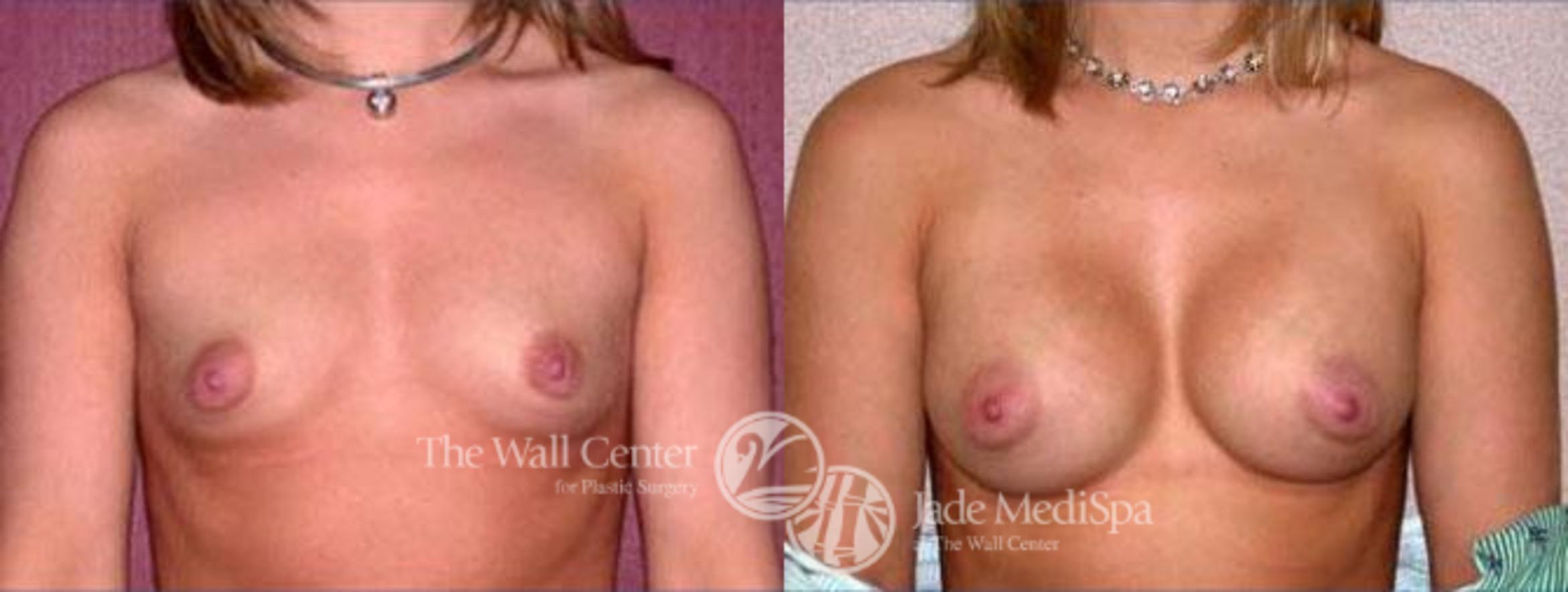 Breast Augmentation Case 111 Before & After View #1 | Shreveport, LA | The Wall Center