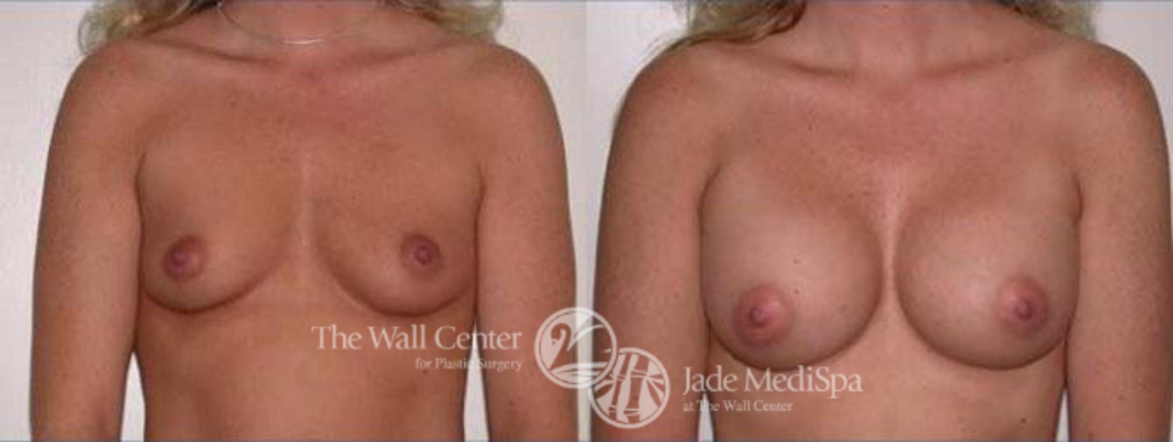 Breast Augmentation Case 114 Before & After View #1 | Shreveport, LA | The Wall Center