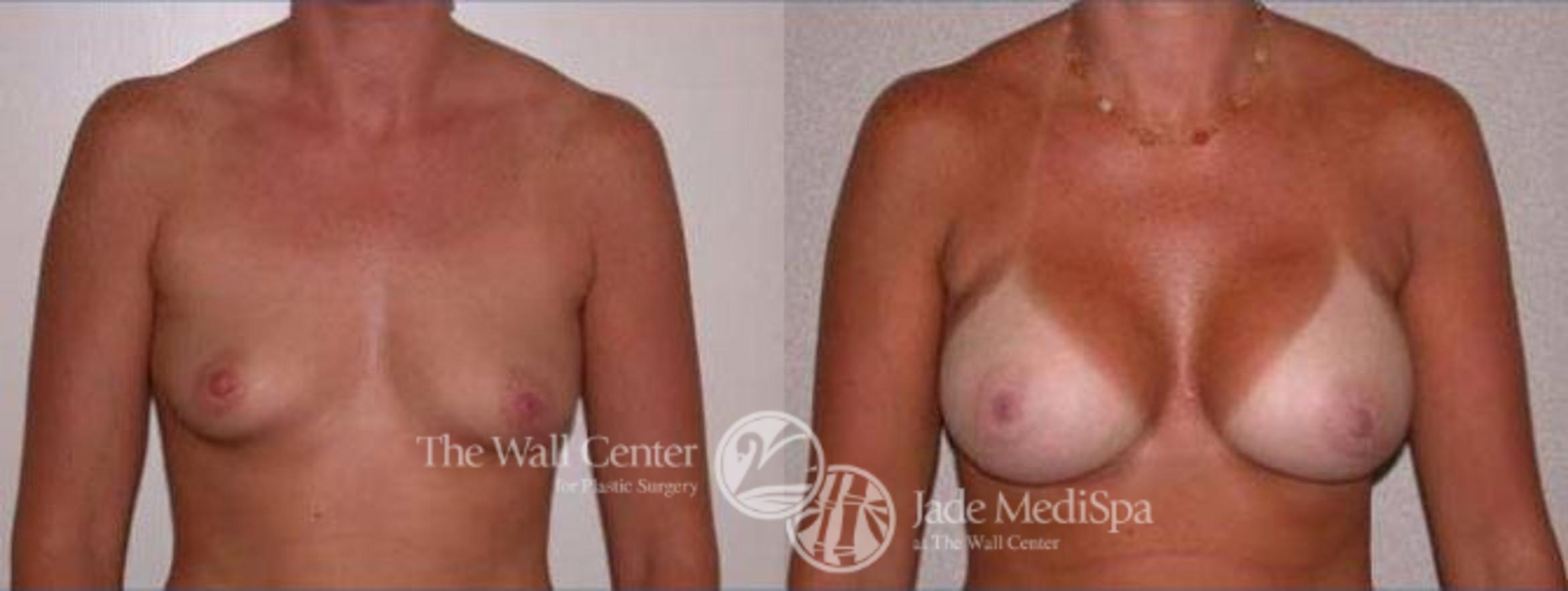 Breast Augmentation Case 115 Before & After View #1 | Shreveport, LA | The Wall Center