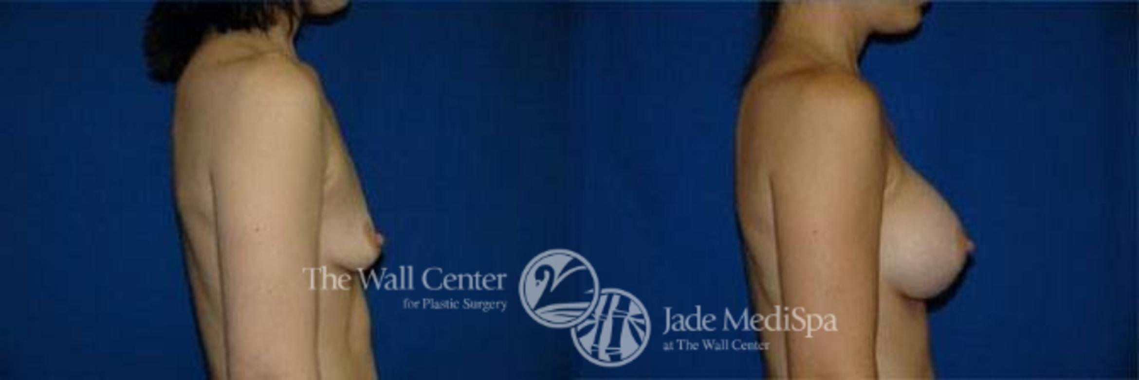 Breast Augmentation Case 117 Before & After View #1 | Shreveport, LA | The Wall Center