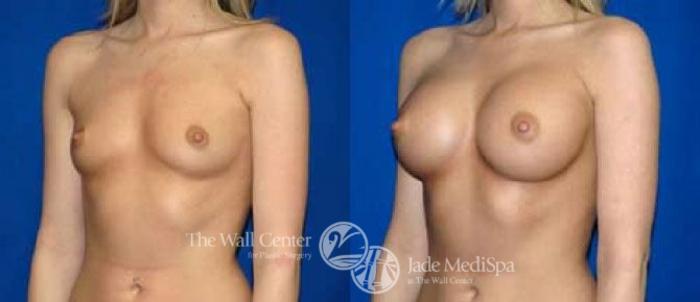 Before & After Breast Augmentation Case 28 View #2 View in Shreveport, LA