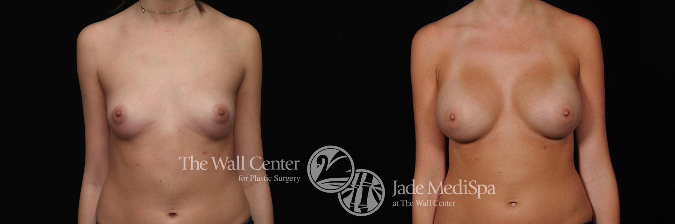 Breast Augmentation Case 285 Before & After View #1 | Shreveport, LA | The Wall Center