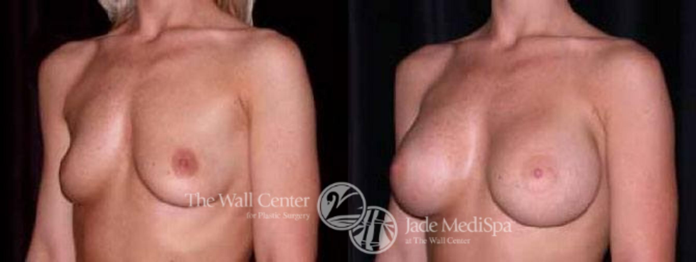 Before & After Breast Augmentation Case 29 View #1 View in Shreveport, LA