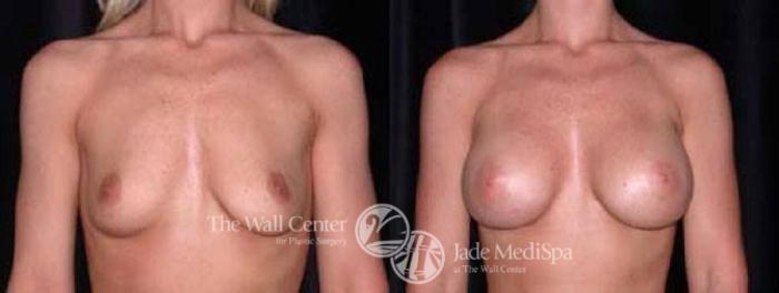 Before & After Breast Augmentation Case 29 View #2 View in Shreveport, LA