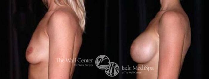 Before & After Breast Augmentation Case 29 View #3 View in Shreveport, LA