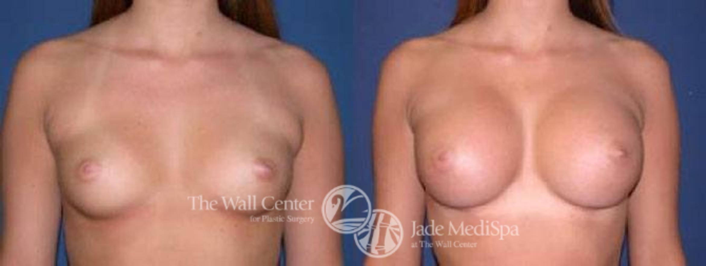 Breast Augmentation Case 31 Before & After View #1 | Shreveport, LA | The Wall Center