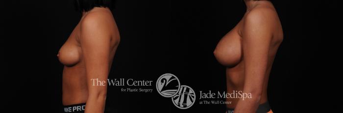 Before & After Breast Augmentation Case 437 View #3 View in Shreveport, LA