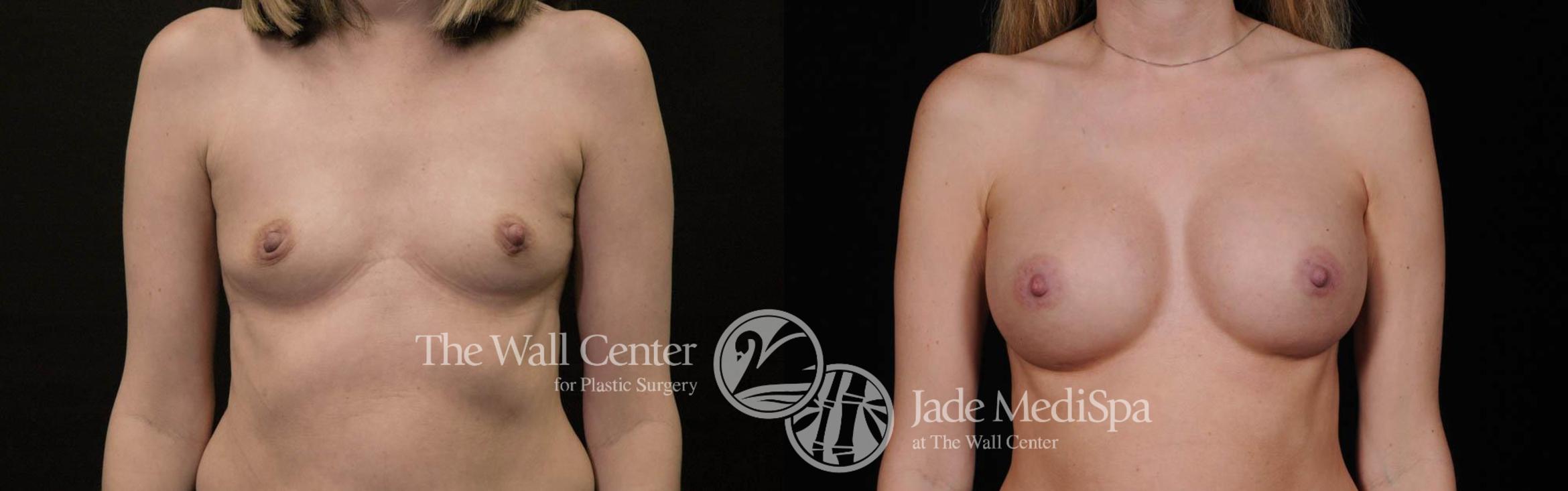 Breast Augmentation Case 438 Before & After View #1 | Shreveport, LA | The Wall Center