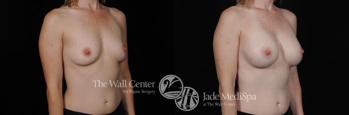 Before & After Breast Augmentation Case 449 View #2 View in Shreveport, LA