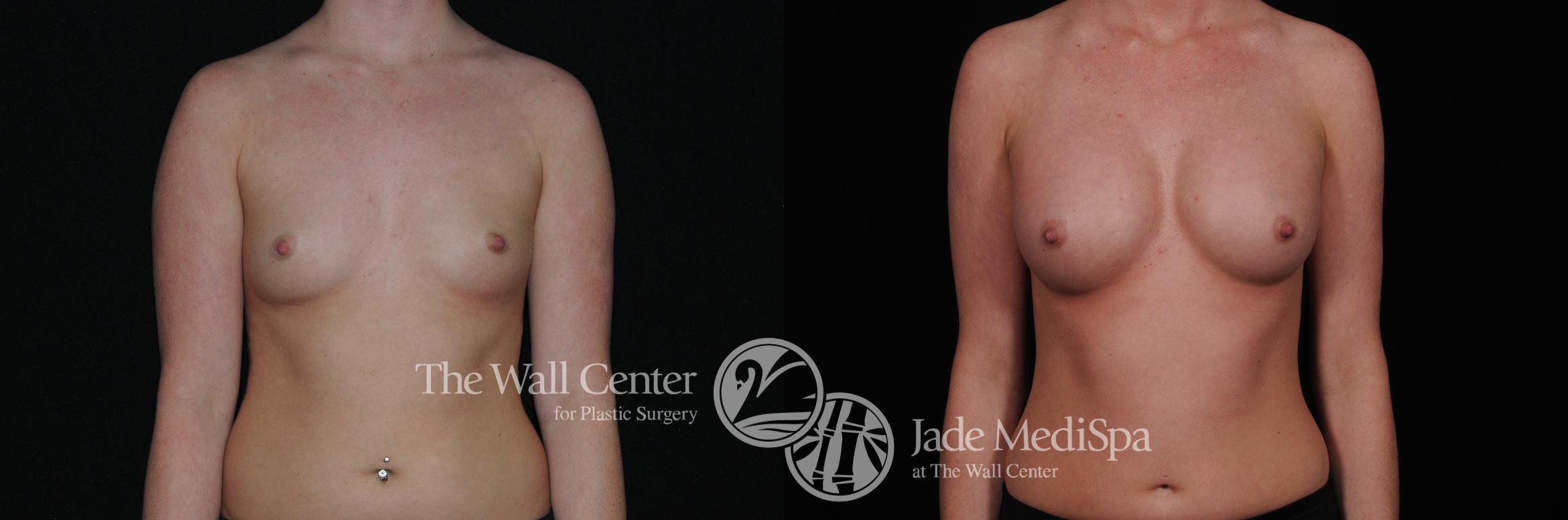 Breast Augmentation Case 451 Before & After View #1 | Shreveport, LA | The Wall Center