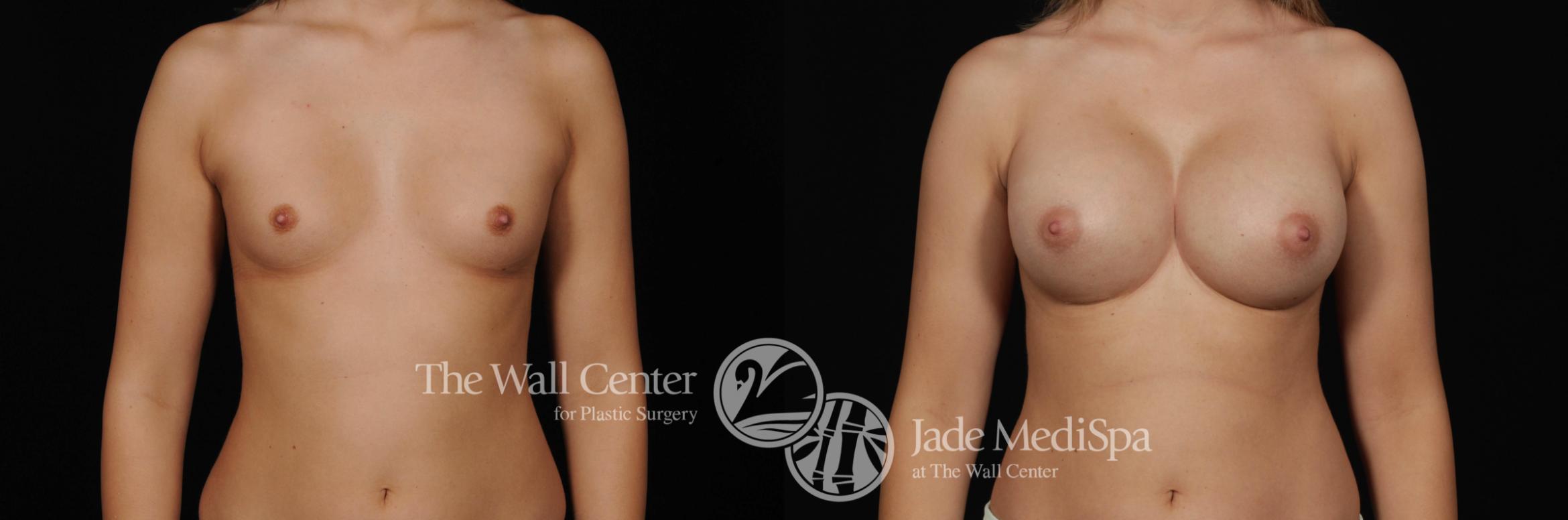 Before & After Breast Augmentation Case 469 View #1 View in Shreveport, LA
