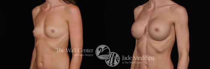 Before & After Breast Augmentation Case 546 View #2 View in Shreveport, LA