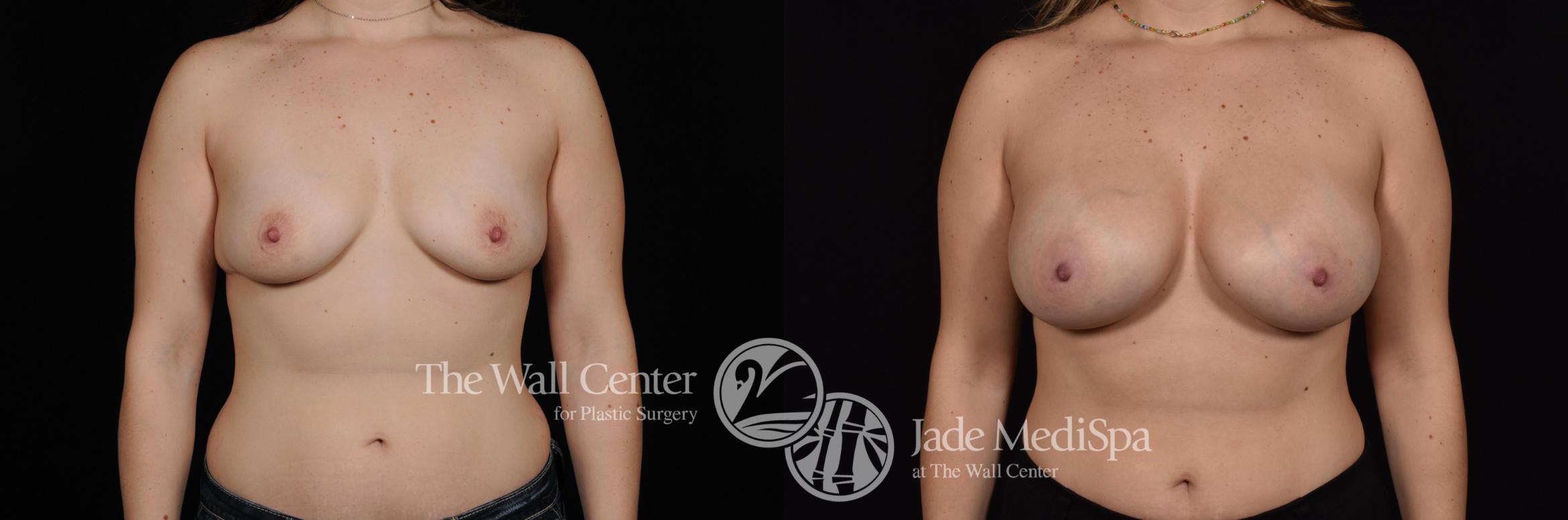 Breast Augmentation Case 549 Before & After View #1 | Shreveport, LA | The Wall Center
