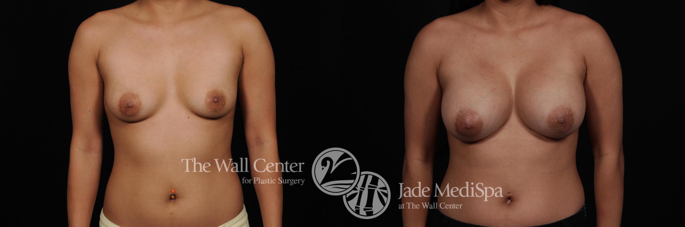 Breast Augmentation Case 553 Before & After View #1 | Shreveport, LA | The Wall Center