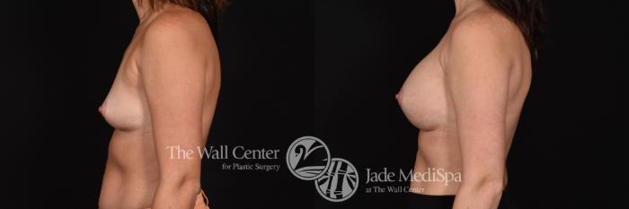 Before & After Breast Augmentation Case 585 View #3 View in Shreveport, LA