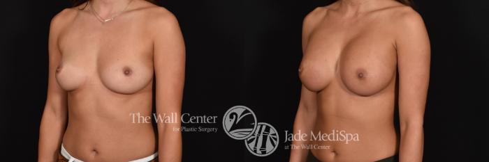 Before & After Breast Augmentation Case 606 View #2 View in Shreveport, LA