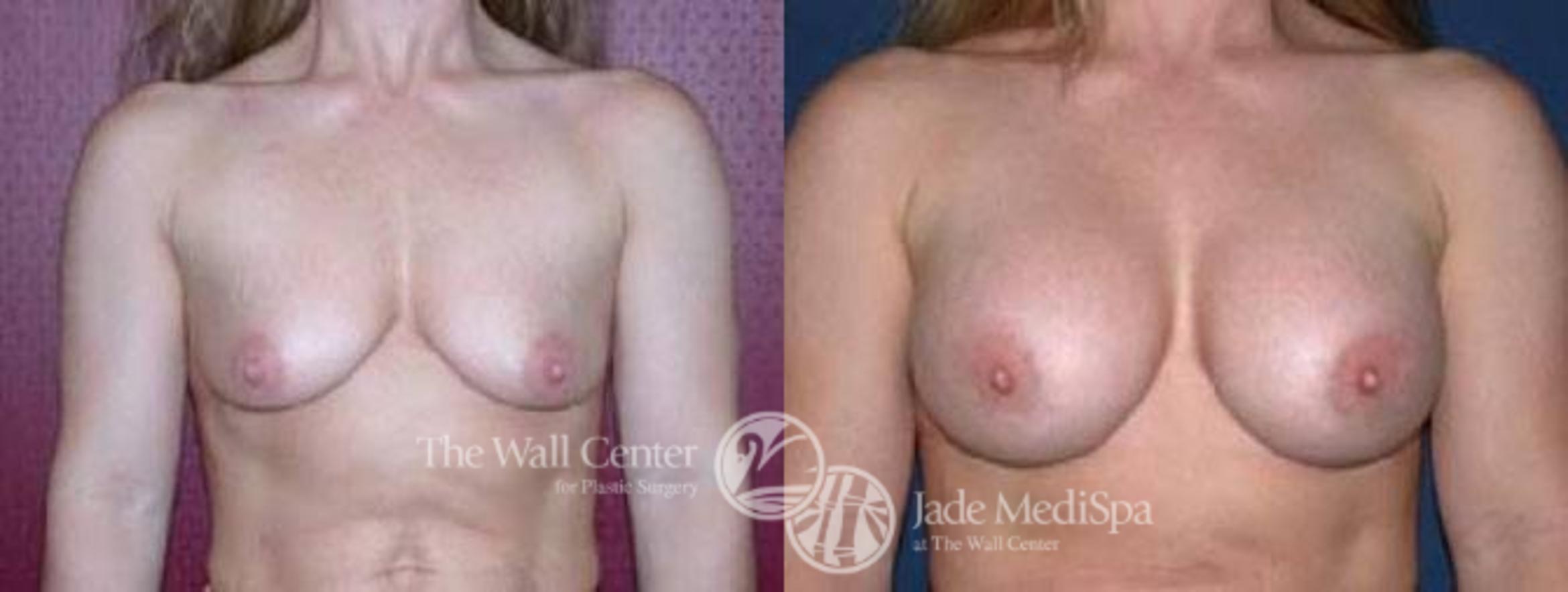 Breast Augmentation Case 61 Before & After View #1 | Shreveport, LA | The Wall Center