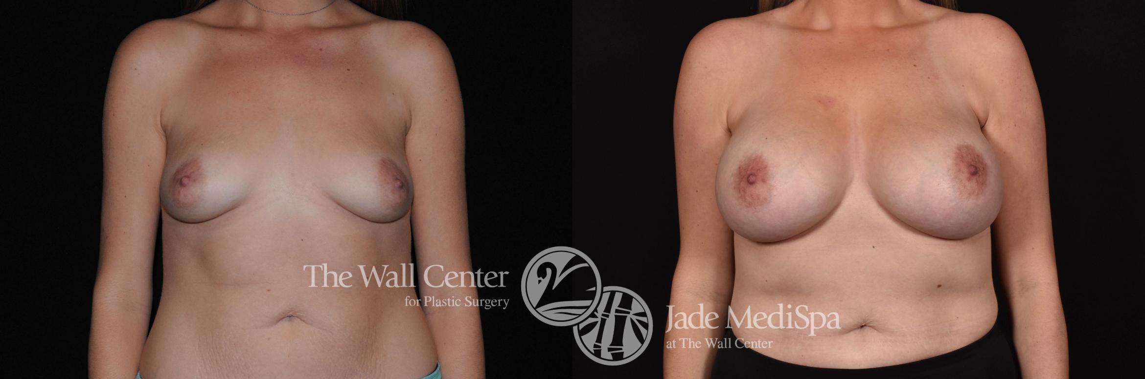 Breast Augmentation Case 736 Before & After VIEW #1 | Shreveport, LA | The Wall Center