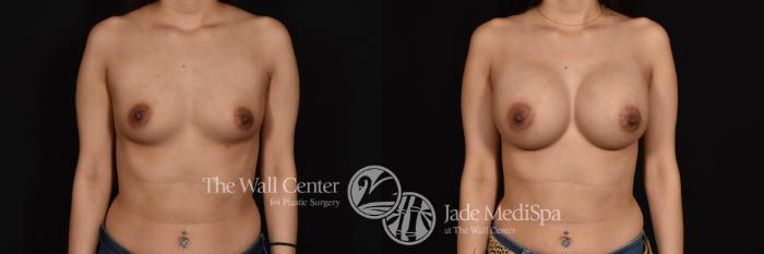 Before & After Breast Augmentation Case 763 VIEW #1 View in Shreveport, LA