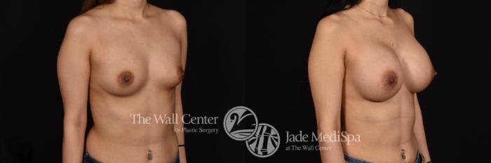 Before & After Breast Augmentation Case 763 VIEW #2 View in Shreveport, LA