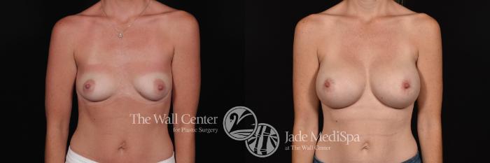 Before & After Breast Augmentation Case 790 VIEW #1 View in Shreveport, LA