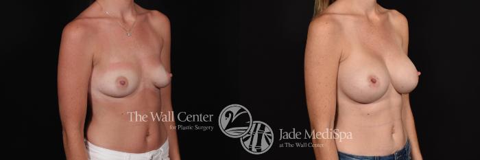 Before & After Breast Augmentation Case 790 VIEW #2 View in Shreveport, LA