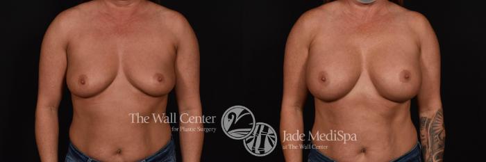 Before & After Breast Augmentation Case 791 VIEW #1 View in Shreveport, LA