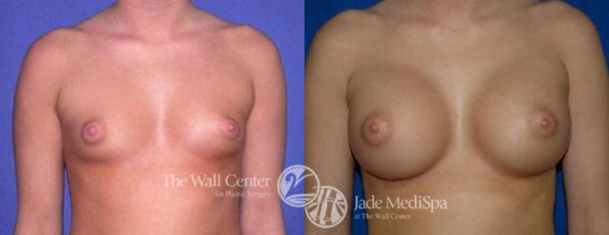 Breast Augmentation Case 91 Before & After View #1 | Shreveport, LA | The Wall Center