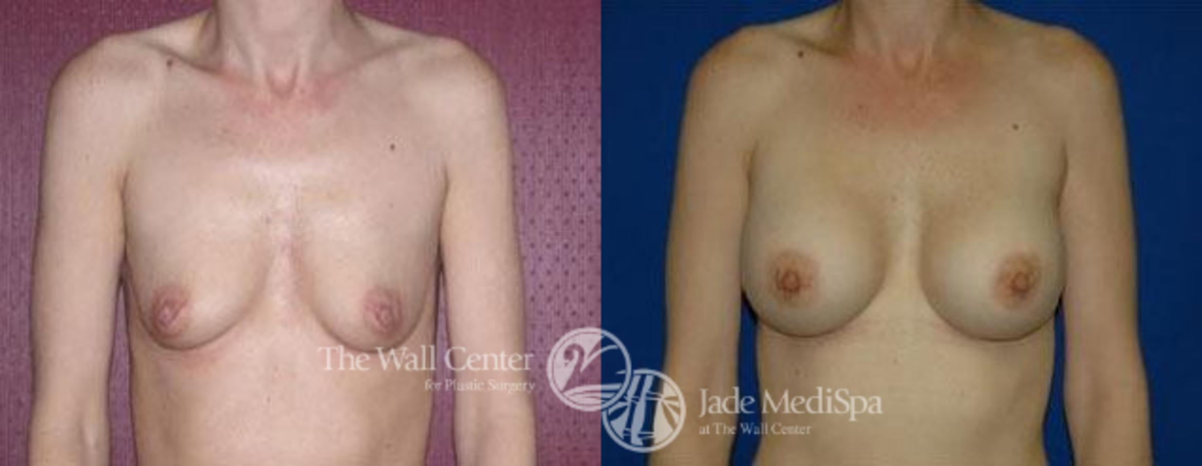 Breast Augmentation Case 94 Before & After View #1 | Shreveport, LA | The Wall Center