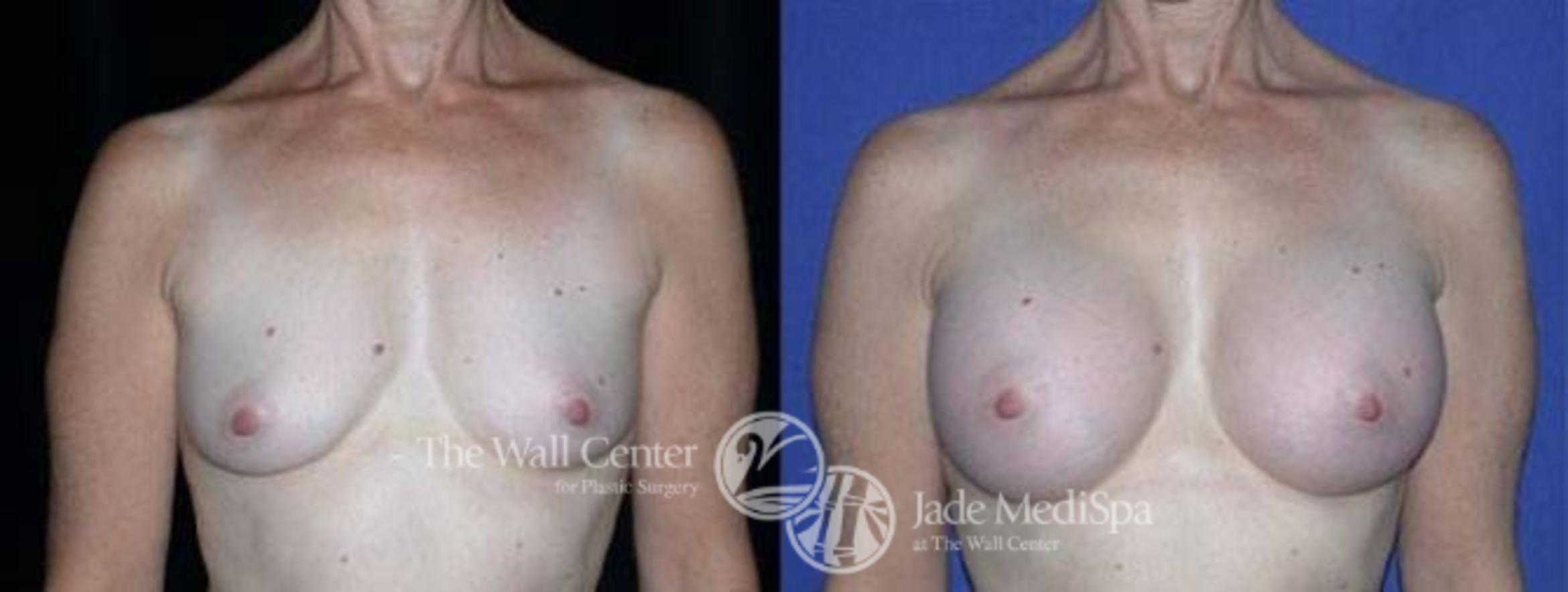 Breast Augmentation Case 95 Before & After View #1 | Shreveport, LA | The Wall Center