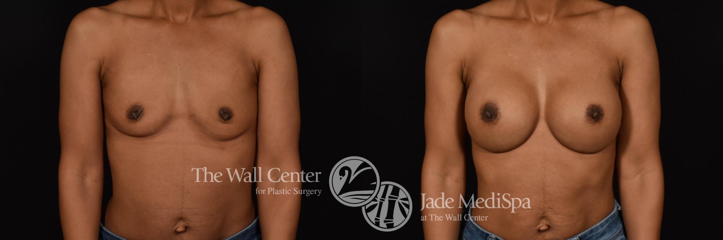 Breast Augmentation Front Photo, Shreveport, Louisiana, The Wall Center for Plastic Surgery, Case 963