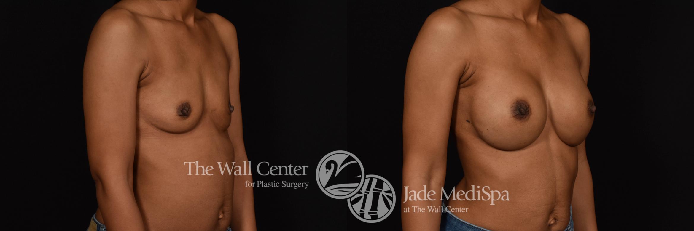 Breast Augmentation Right Oblique Photo, Shreveport, Louisiana, The Wall Center for Plastic Surgery, Case 963