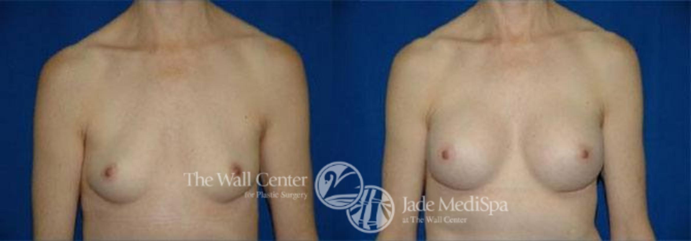 Breast Augmentation Case 97 Before & After View #1 | Shreveport, LA | The Wall Center