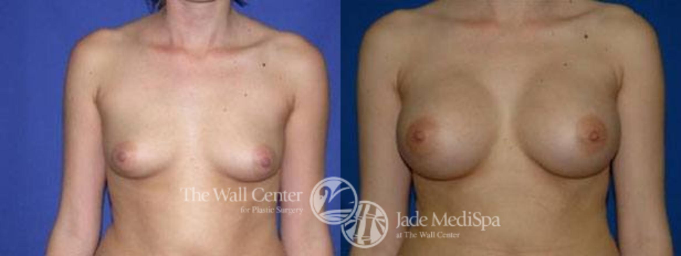 Breast Augmentation Case 99 Before & After View #1 | Shreveport, LA | The Wall Center