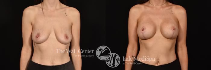 Before & After Breast Augmentation with Lift Case 1126 Front View in Shreveport, LA