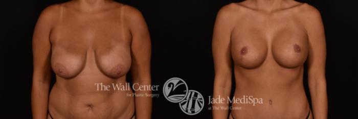 Before & After Breast Augmentation with Lift Case 1186 Front View in Shreveport, LA