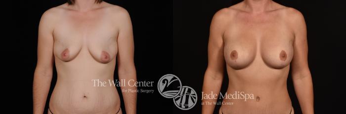 Before & After Breast Augmentation with Lift Case 1271 Front View in Shreveport, LA