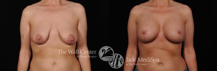 Before & After Breast Augmentation with Lift Case 450 View #1 View in Shreveport, LA
