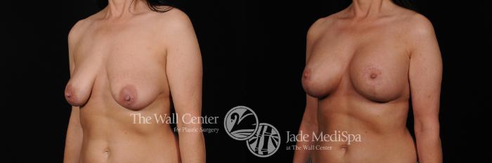 Before & After Breast Augmentation with Lift Case 450 View #2 View in Shreveport, LA