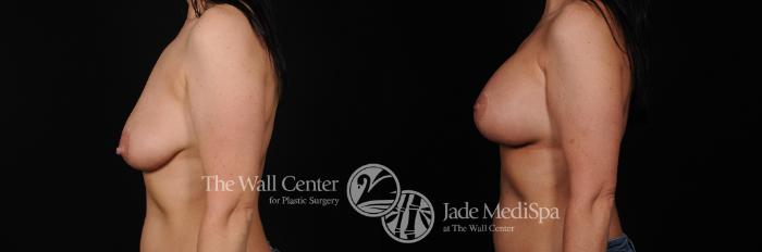 Before & After Breast Augmentation with Lift Case 450 View #3 View in Shreveport, LA