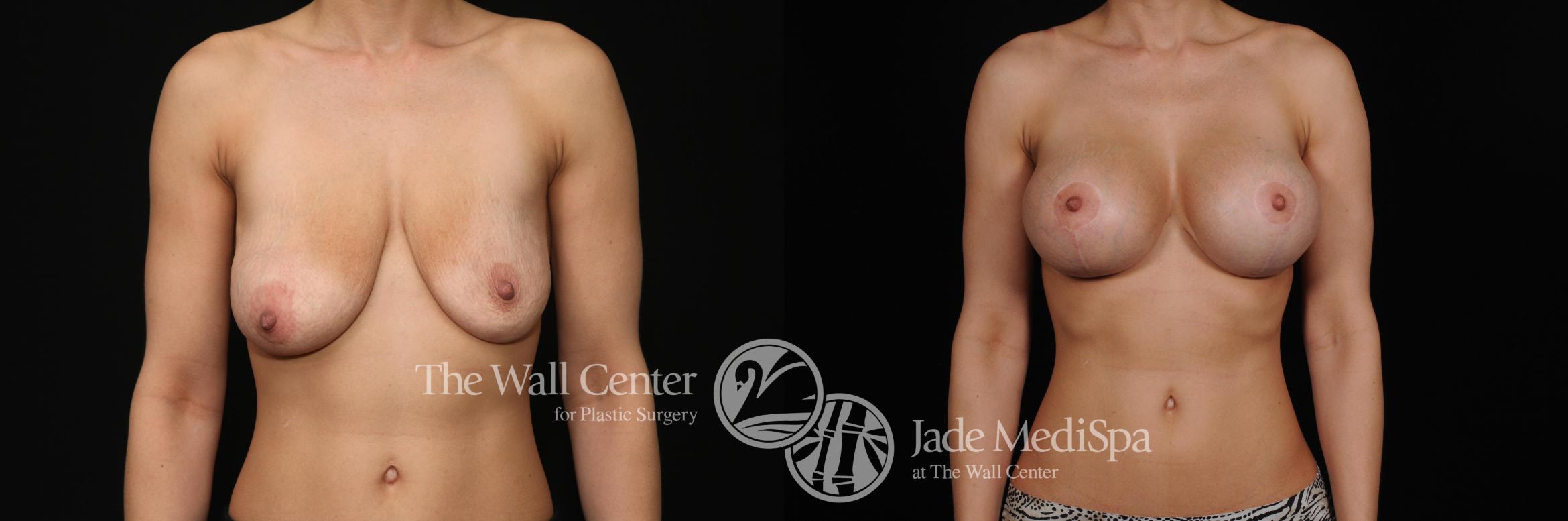 Breast Augmentation with Lift Case 454 Before & After View #1 | Shreveport, LA | The Wall Center