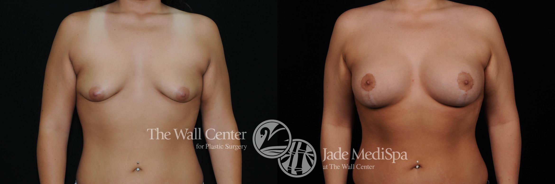 Before & After Breast Augmentation with Lift Case 461 View #1 View in Shreveport, LA
