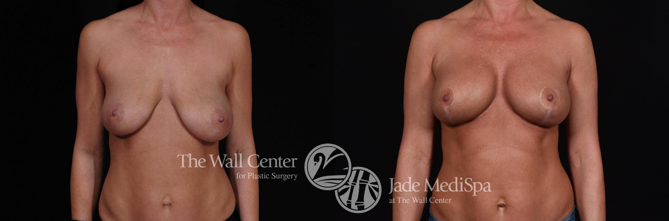 Before & After Breast Augmentation with Lift Case 550 View #1 View in Shreveport, LA