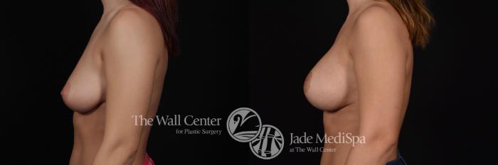 Before & After Breast Augmentation with Lift Case 587 View #3 View in Shreveport, LA