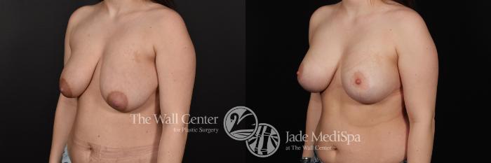 Before & After Breast Augmentation with Lift Case 669 VIEW #2 View in Shreveport, LA