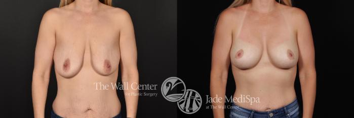 Before & After Breast Augmentation with Lift Case 670 VIEW #1 View in Shreveport, LA